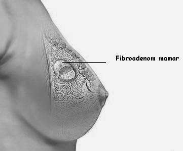 imagini/poza tumorile mamare